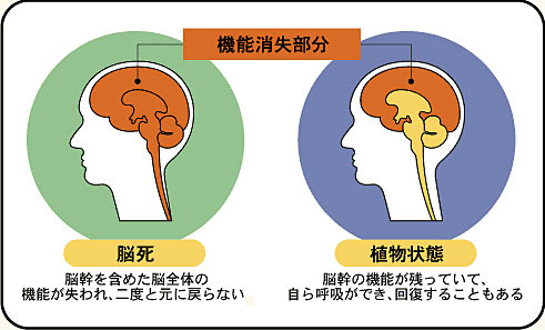 脳死 は 人 の 死 か ディベート